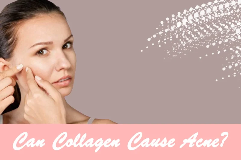 Can Collagen Cause Acne? Facts, Causes, and Skin Insights