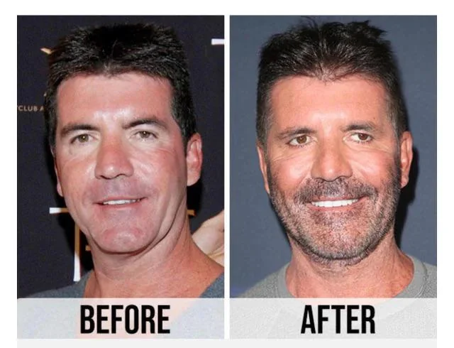 Simon Cowell Before and After plastic surgery